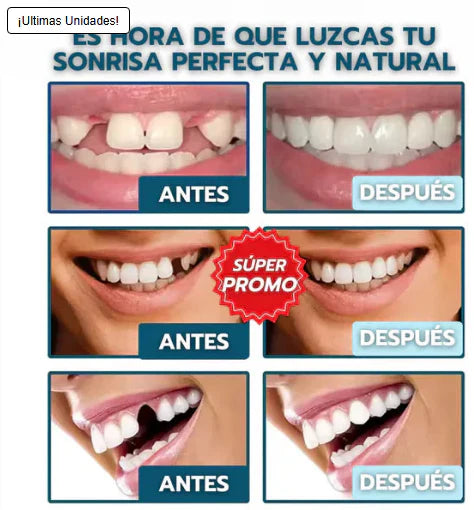 Carillas  SmileInstant™: ocultan manchas, espacios y torceduras en minutos, desde casa