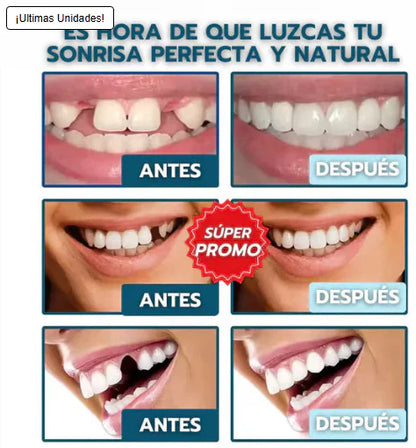 Carillas  SmileInstant™: ocultan manchas, espacios y torceduras en minutos, desde casa