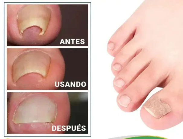 Eliminador de hongos de Uñas Natural | 7 DAYS
