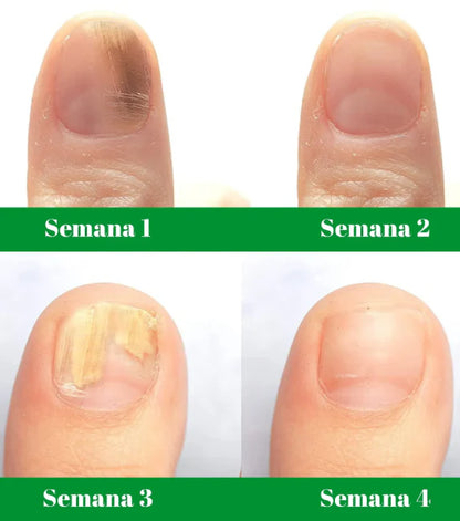 Eliminador de hongos de Uñas Natural | 7 DAYS