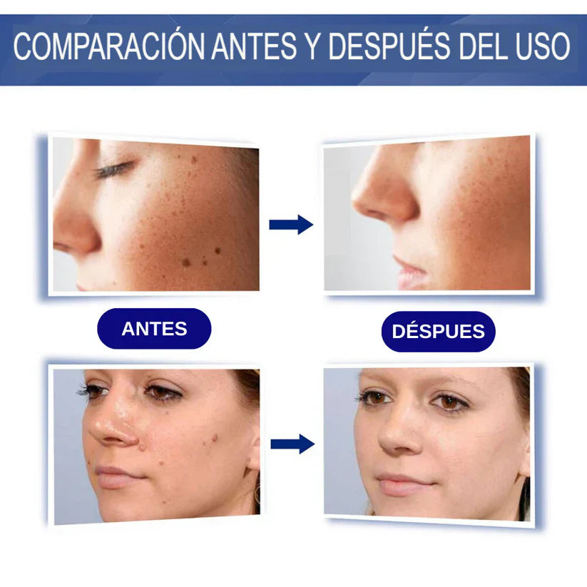 Crema Elimina Verrugas - Resultados visibles que devuelven tu seguridad