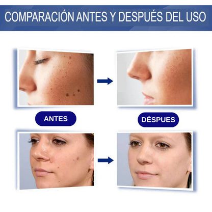 Crema Elimina Verrugas - Resultados visibles que devuelven tu seguridad